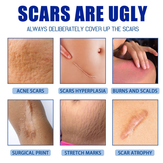 Scar Removal Cream (6 Pack): Advanced Skin Repair for Surgical Scars, Acne Marks, Stretch Marks & Burn Scars | Gentle Formula for All Skin Types