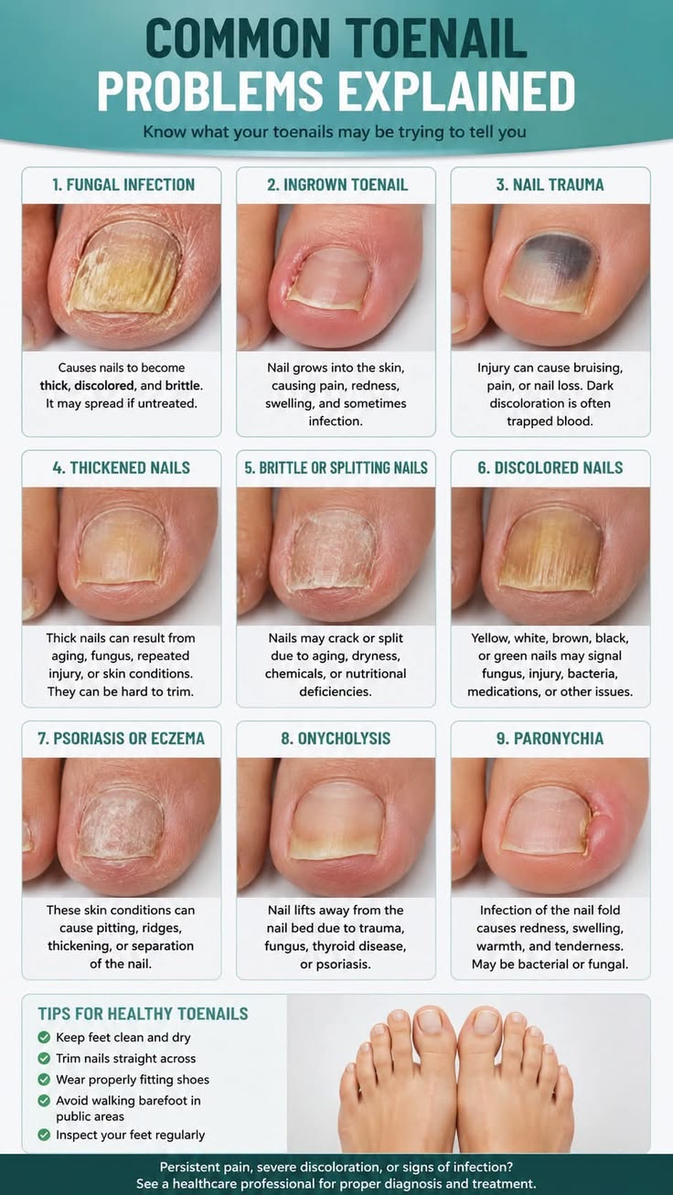 Best Toenail Care Pens for Fungal Infections: Safe At-Home Treatment Guide
