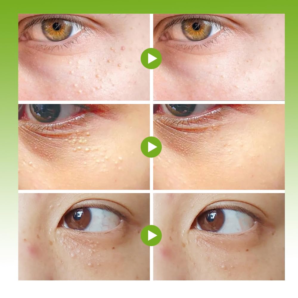2-Pack Vitamin E Fat Granule Cream with AHA for Skin Care, Fruit-based Moisturizing, Effectively Improve Eye-area Fat Granules and Nourish Skin