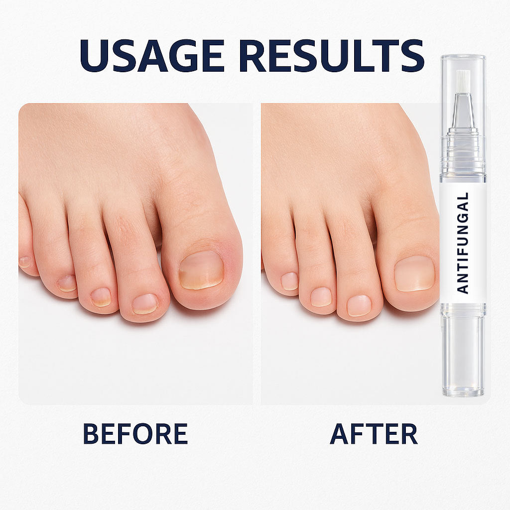 Nail Care Pen (3-Pack) - 25% Undecylenic Acid & Tea Tree Oil, Nourishing Formula for Healthy-Looking Fingernails & Toenails, 3ml per Pen (Pack of 3/4)